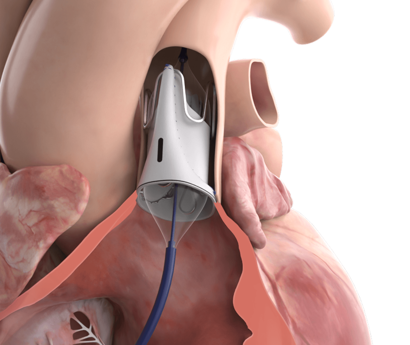 transcatheter balloon