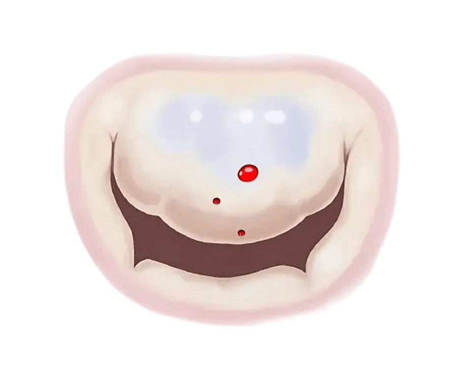 Can Mitral Regurgitation get worse