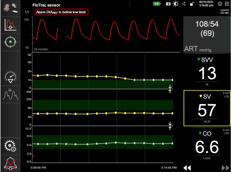 FloTrac Sensor | Edwards Lifesciences