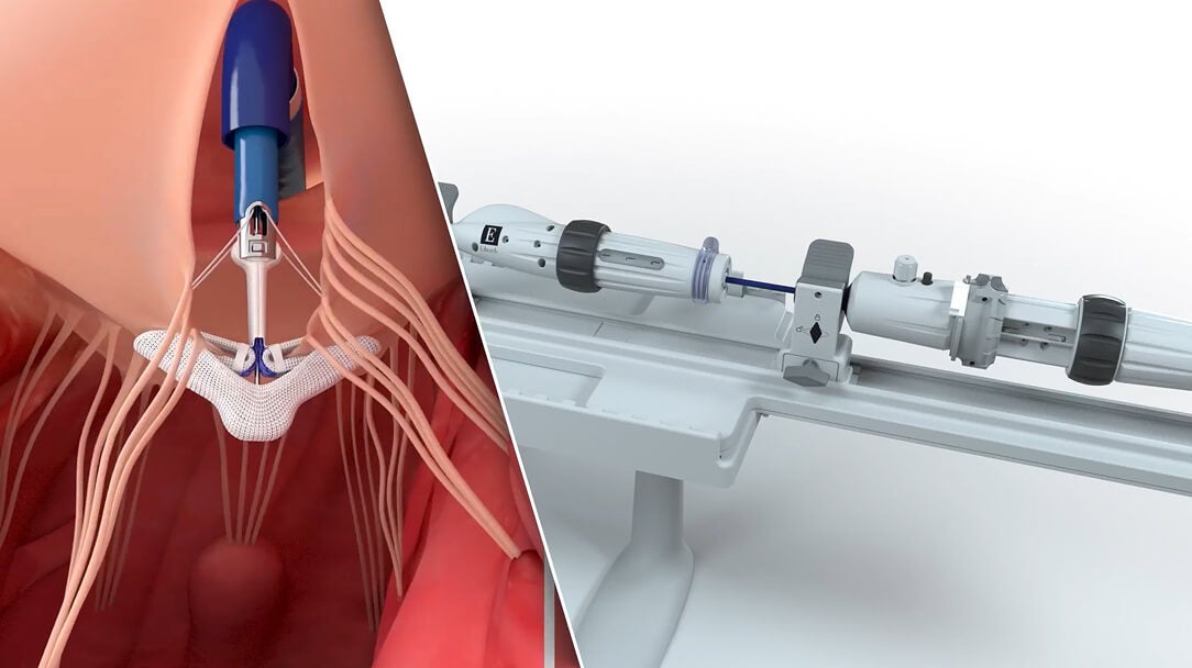 Transcatheter edge-to-edge video thumbnail