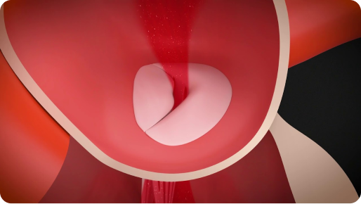 Mitral valve with regurgitation (regurgitation)