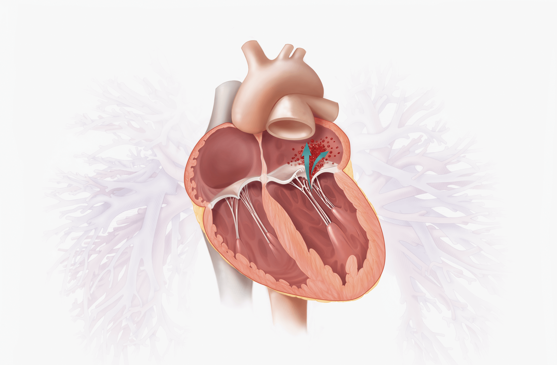 Degenerative MR (DMR) 1