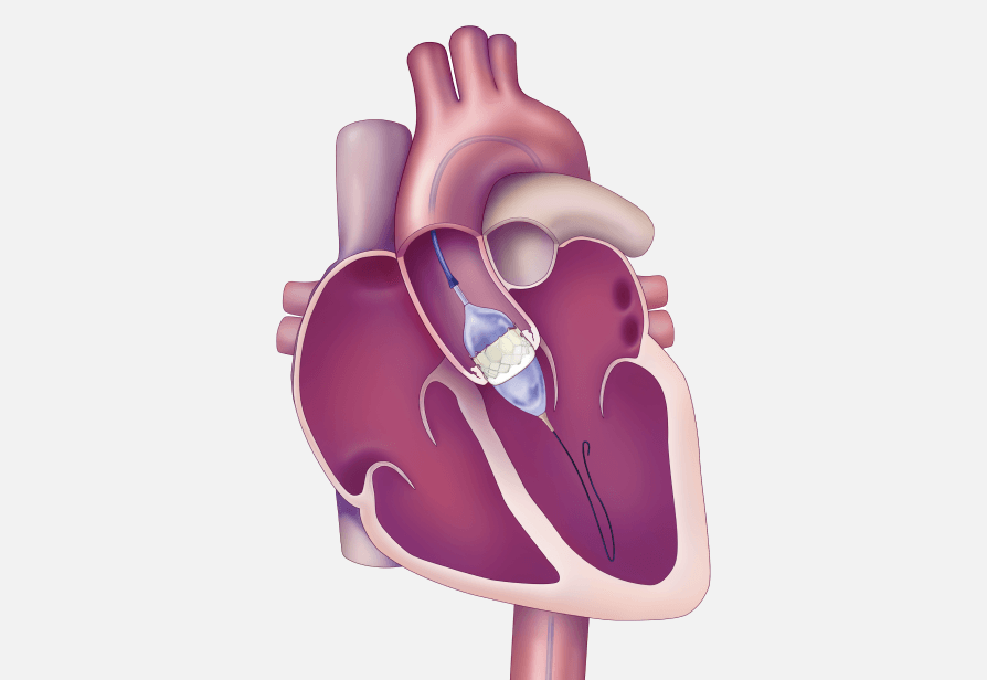 Válvulas cardiacas transcatéter | Edwards Lifesciences