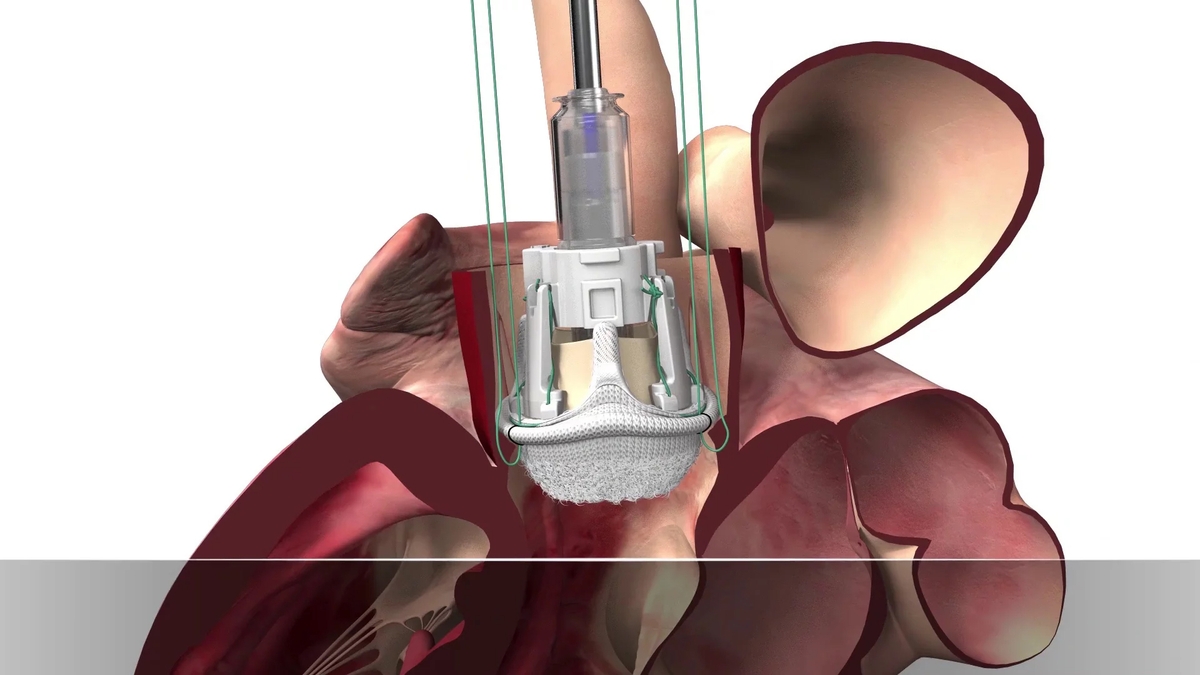 Système de valve Edwards Intuity Elite | Edwards Lifesciences