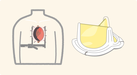 Open heart surgery (valve replacement, AVR)