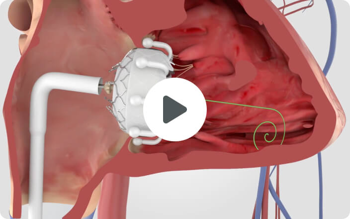 How is TTVR performed