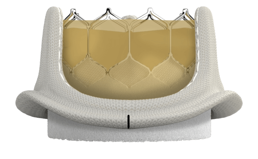 SAPIEN 3 Ultra RESILIA valve in an INSPIRIS RESILIA valve