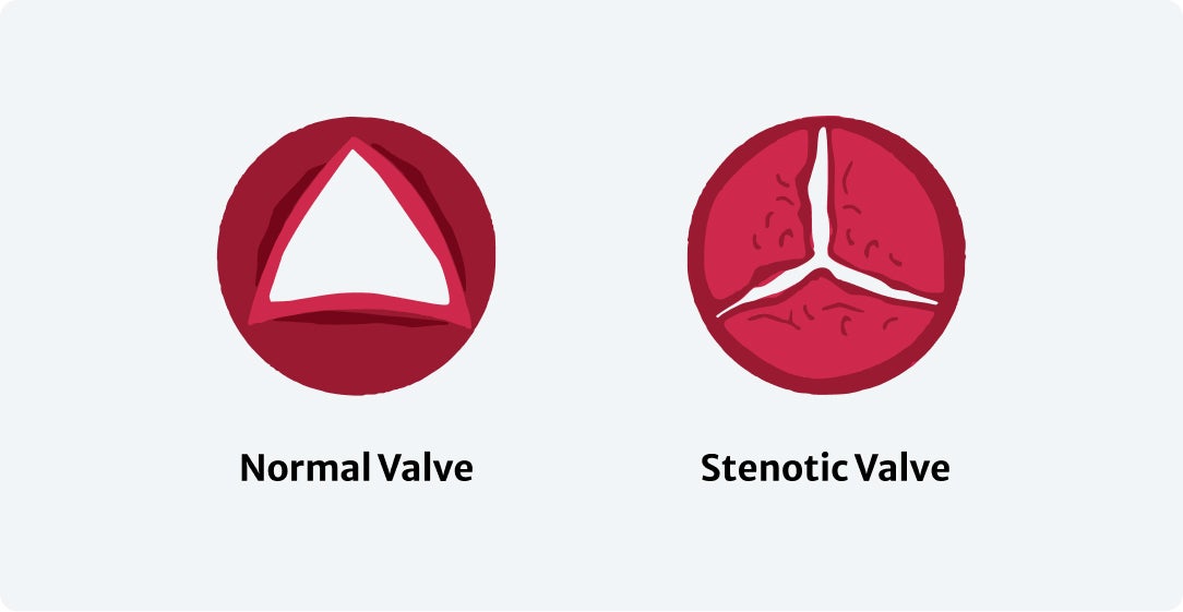 Aortic Stenosis - Image