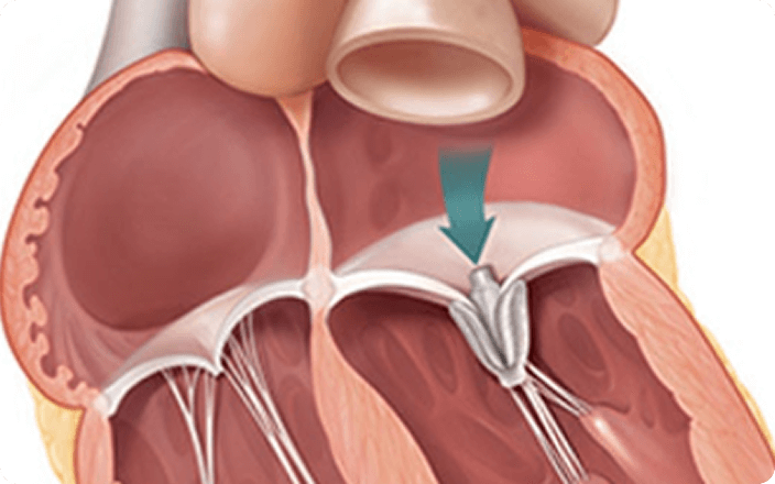 TEER procedure step 5