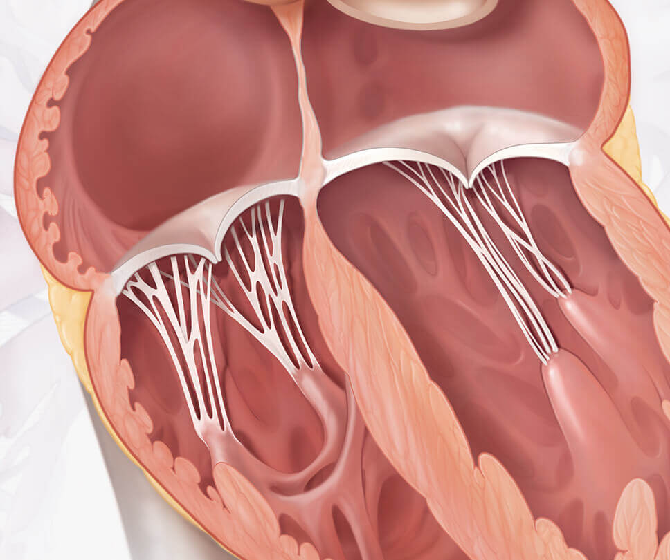 TRISCEND II Trial For Tricuspid Regurgitation | Edwards Lifesciences