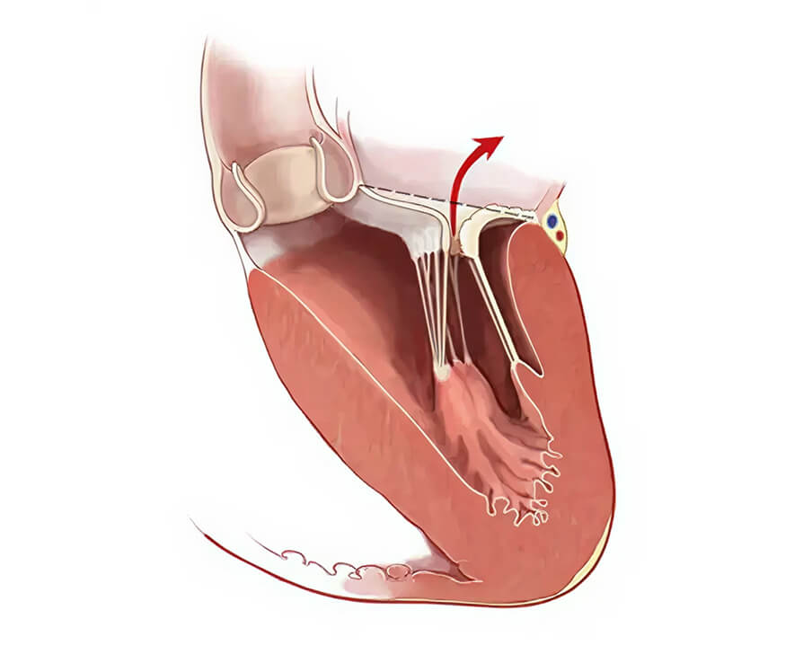 Cause of Mitral Regurgitation
