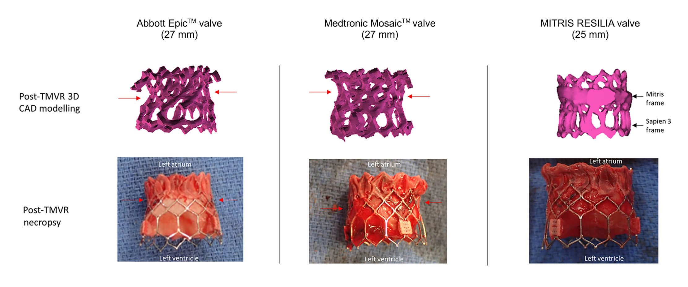 The MITRIS RESILIA valve enabled optimal expansion