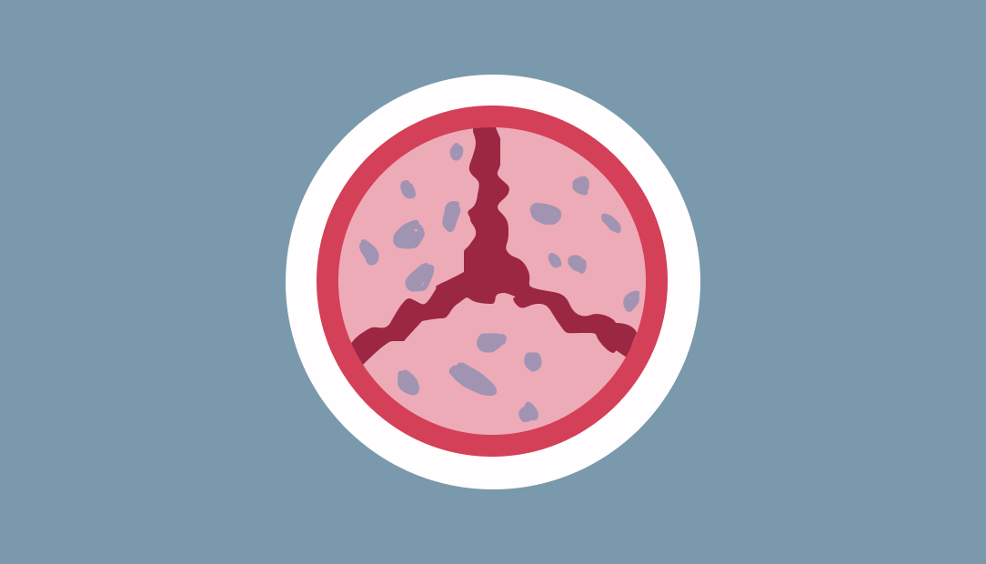 severe aortic stenosis