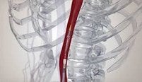 Transcatheter SAPIEN 3 TAVR gallery item 1