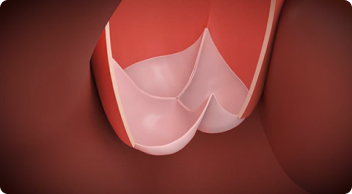 Normal valve movement 