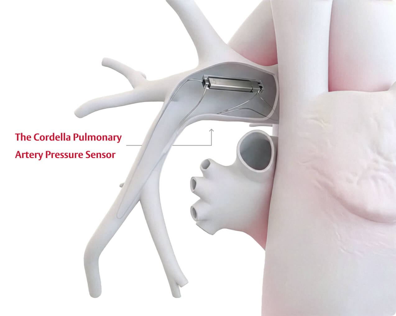 implant procedure