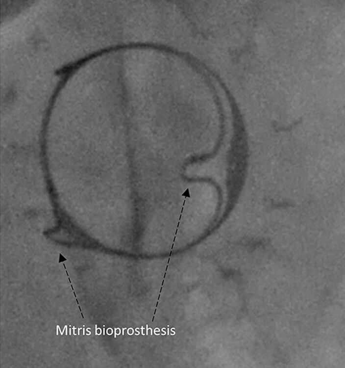 MITRIS RESILIA valve