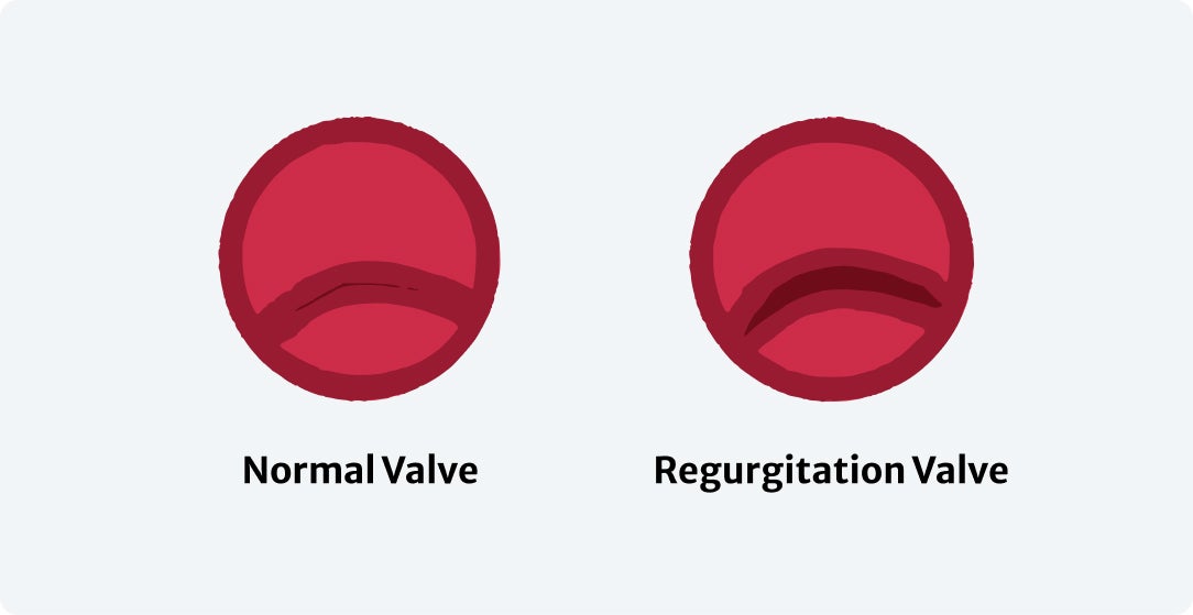 Mitral Regurgitation - Image