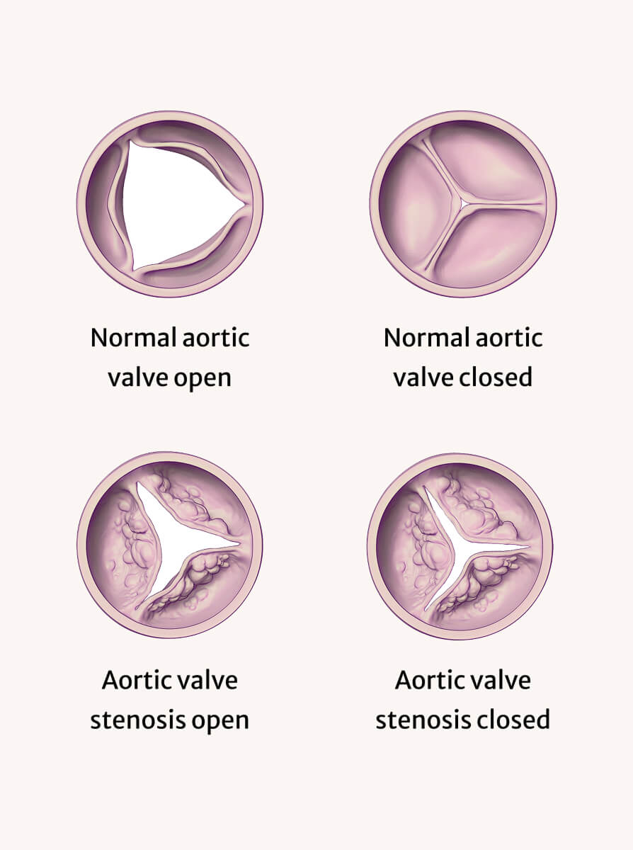 Main cause of Aortic Stenosis