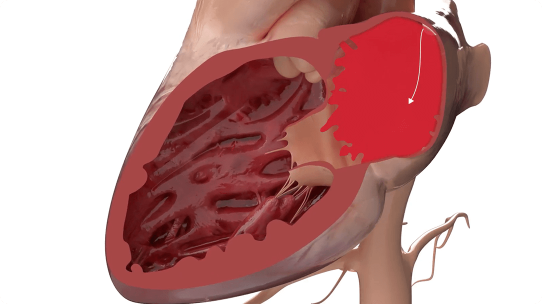 What is mitral regurgitation
