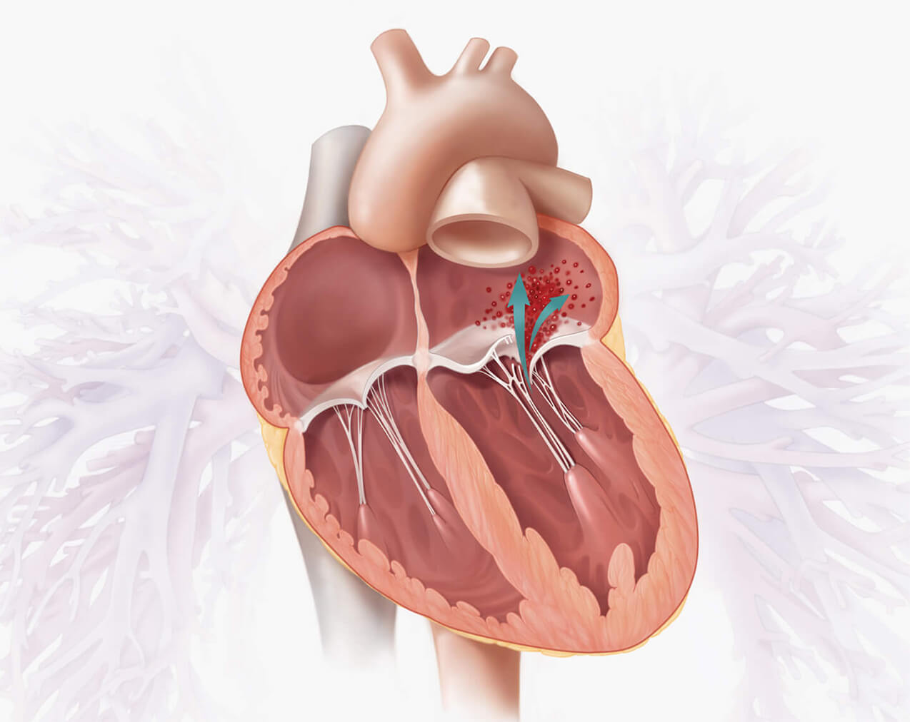 understanding-degenerative-mitral-valve-regurgitation-treatment