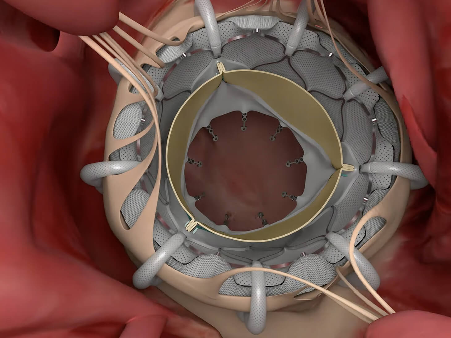 The implant is released and stays in the heart