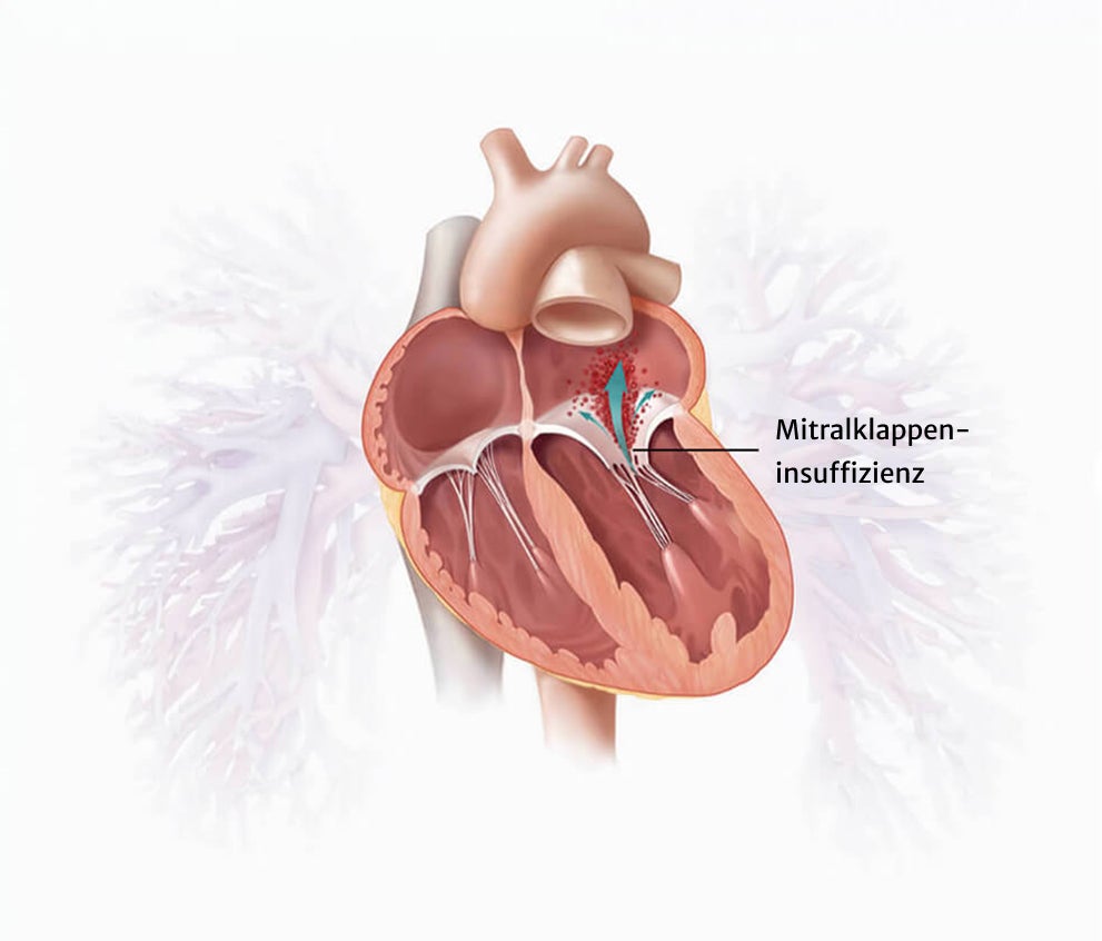 Mitral regurgitation