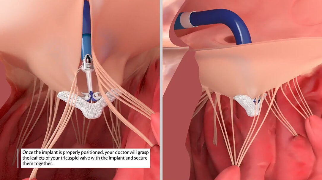How is TEER performed