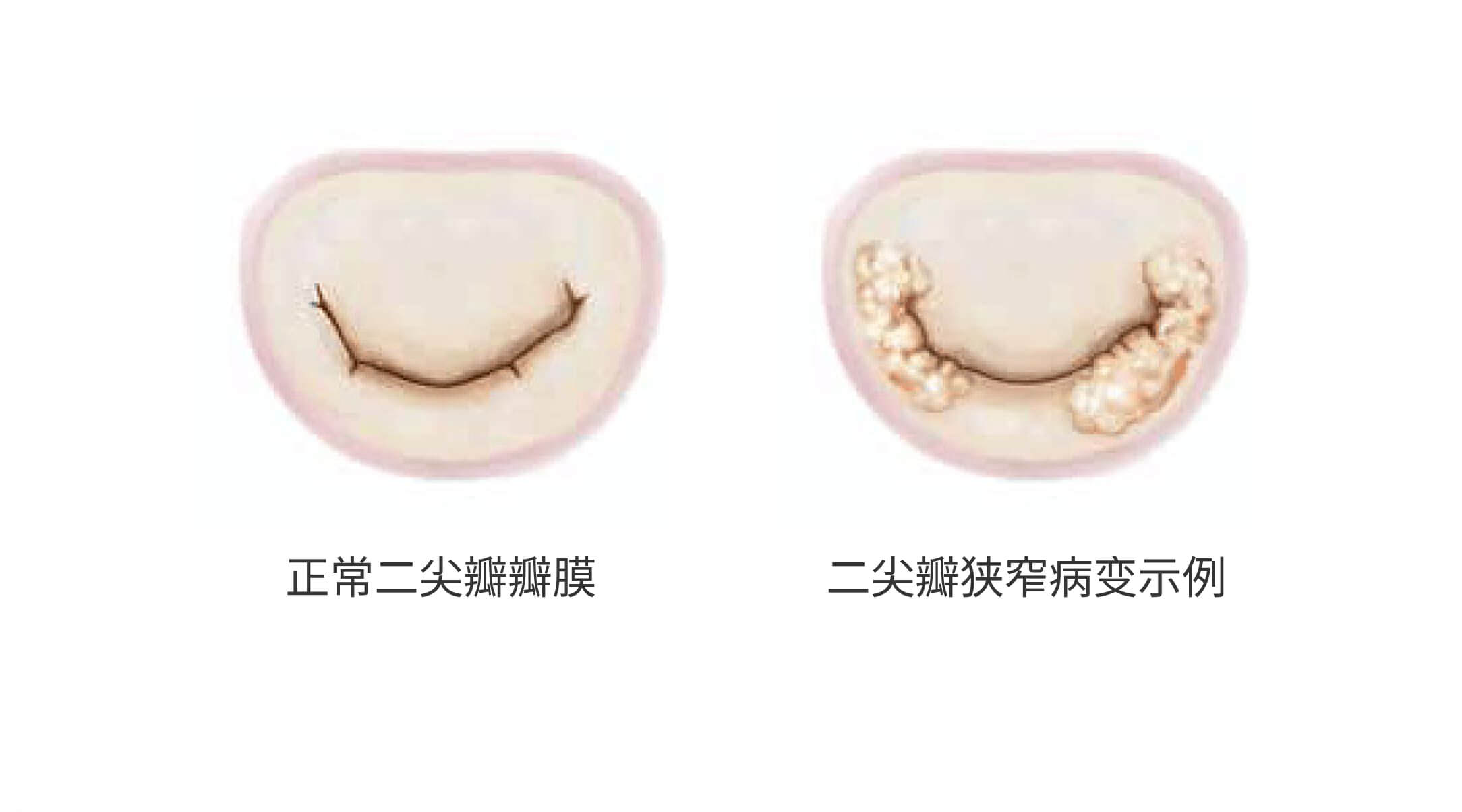 Mitral valve comparison