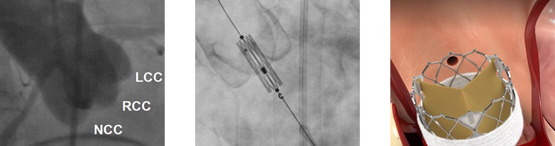 Commissural alignment being studied