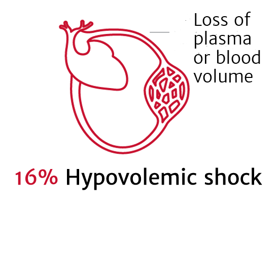 Hypovolemic shock