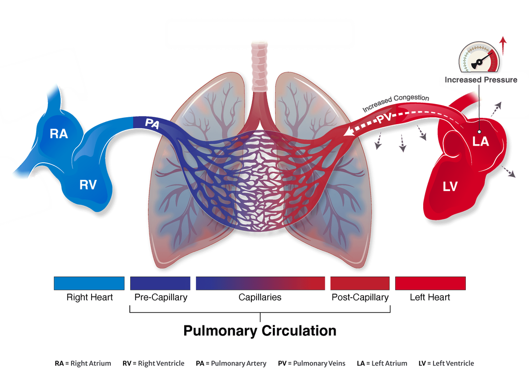 ALT-FLOW trial | Edwards Lifesciences