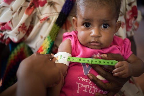 A young girl is being monitored for progress in Eastern Highlands Province in Papua New Guinea. Nearly one in two children in Papua New Guinea are suffering from malnutrition.  