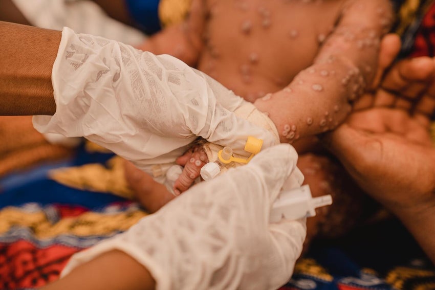 A baby with mpox being cared for