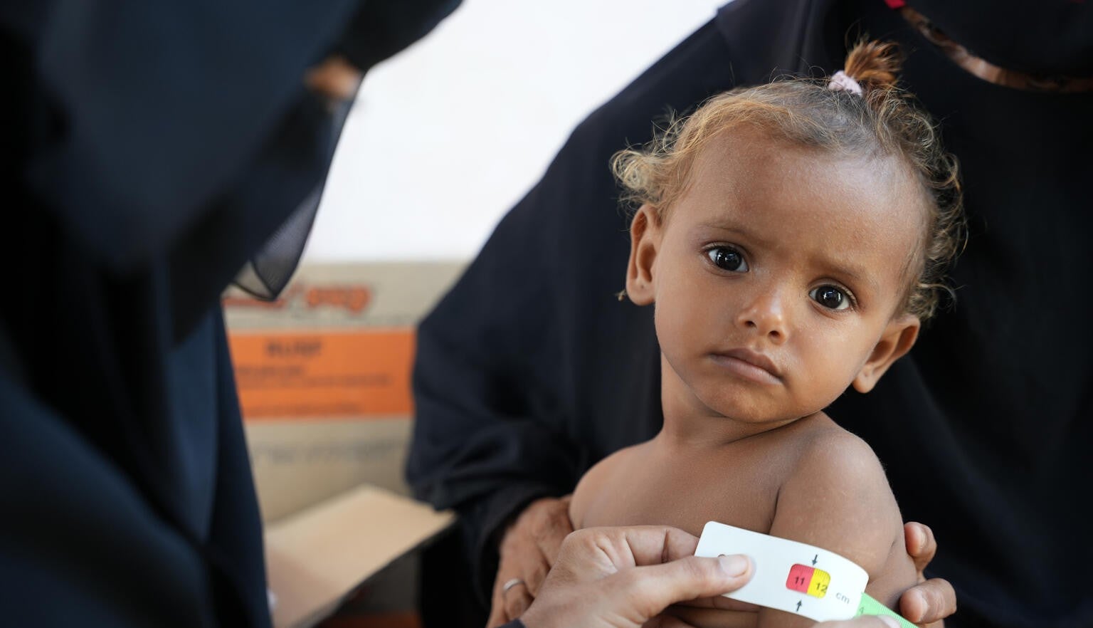 A young baby in Yemen being treated for malnutrition