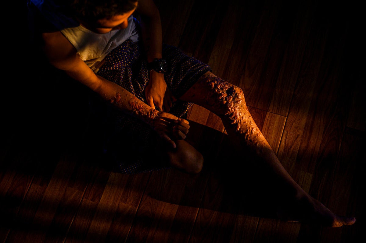 14-year-old Paing stepped on a landmine, tragically losing his right leg, and his hands and other leg were badly injured. 