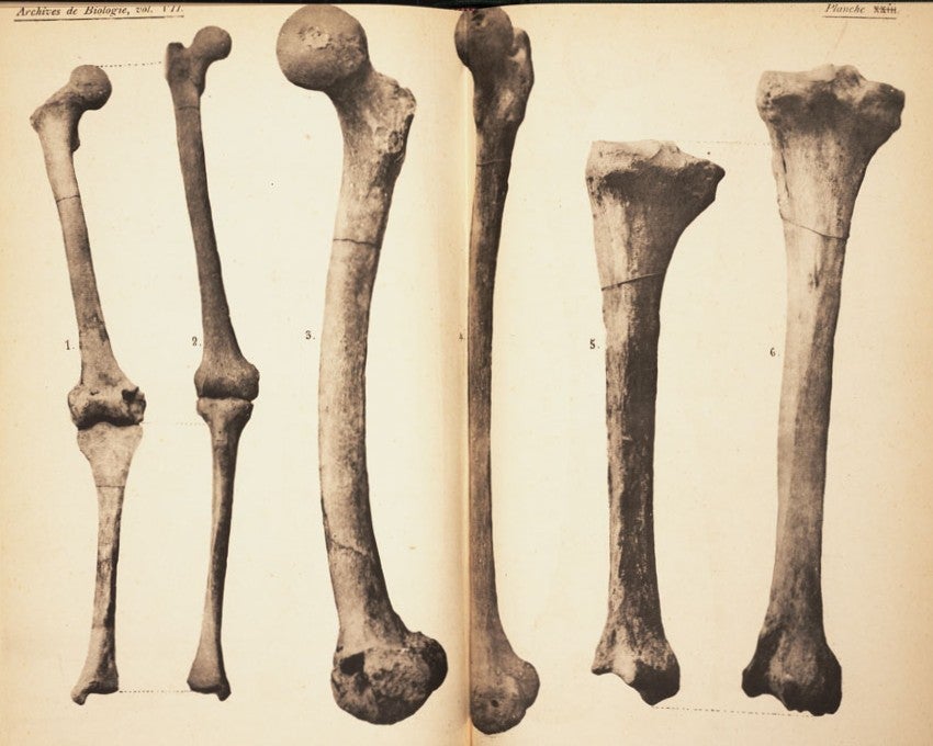 Neanderthal femur and tibias. Image source: Fraipont, Julien and Max Lohest. "La race humaine de Neanderthal ou de Canstadt en Belgique." Archives de Biologie, vol. 7, 1887, pl. 20.
