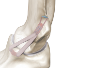 ligamento colateral lateral del codo