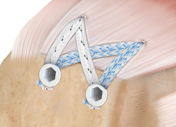 Arthrex - Rotator Cuff Tear