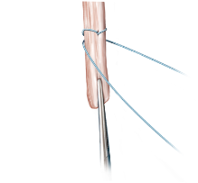 Arthrex - 4-0 FiberLoop Suture, 6 in (Blue) w/Tapered Needle