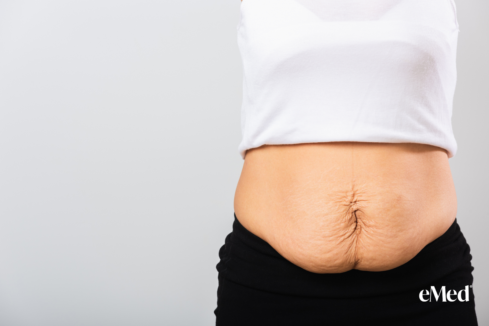 Prevent Loose Skin During Weight Loss Expert Tips eMed UK