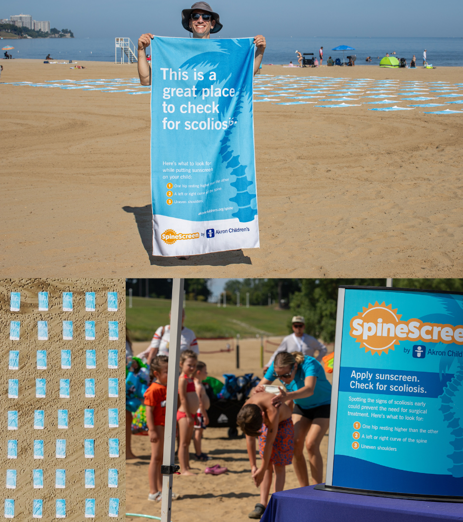 Beach activation for SpineScreen scoliosis awareness campaign, showing a person holding a blue towel that reads ‘This is a great place to check for scoliosis,’ sunscreen samples arranged in the sand, and a clinician checking a child’s posture near a SpineScreen information sign.