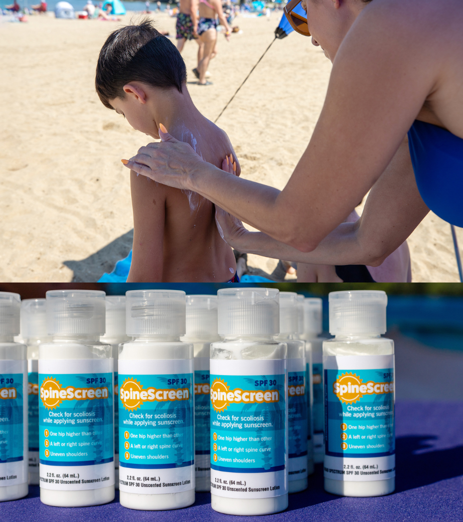Adult applying sunscreen to a child’s back at the beach as part of the SpineScreen scoliosis awareness initiative, with rows of SpineScreen SPF 30 sunscreen bottles displayed in the foreground.