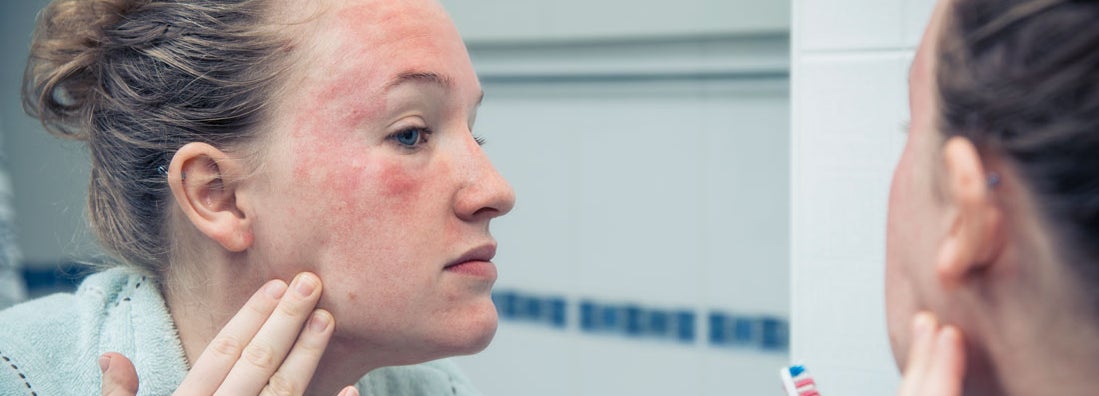 Skin rash
