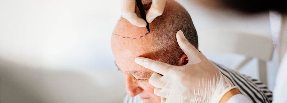 Hair transplant patient. Find hair replacement service insurance.