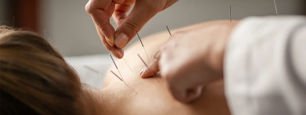 Acupuncture back treatment, therapist and patient. Find Acupuncture Insurance.