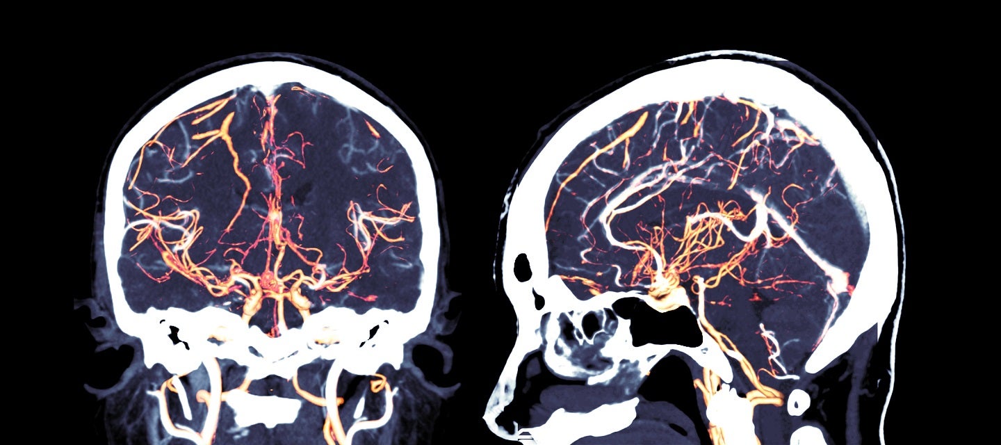 Image of a persons head using CT angiography