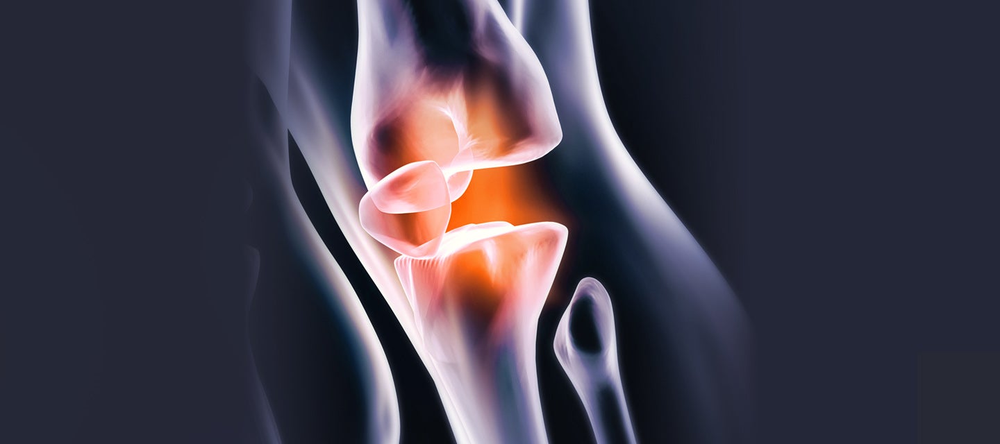 A graphic of knee bones 