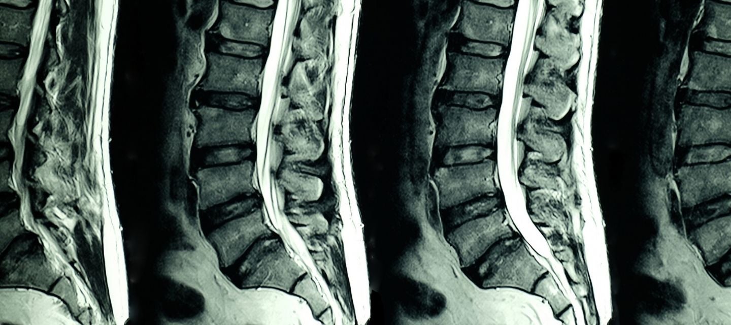 lumbar spine mri