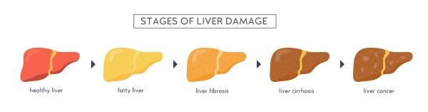 The stages of liver disease